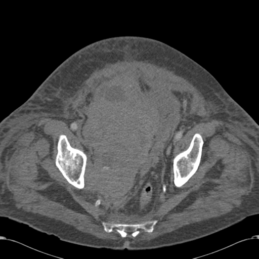 File:Abdominal hematoma (Radiopaedia 33614-34715 Axial C+ portal venous phase 115).png