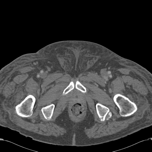 File:Abdominal hematoma (Radiopaedia 33614-34715 Axial C+ portal venous phase 139).png