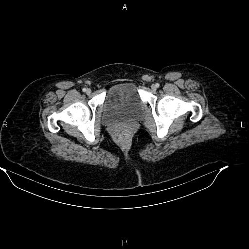 File:Abdominal lymphoma with sandwich sign (Radiopaedia 84378-99704 Axial C+ portal venous phase 57).jpg