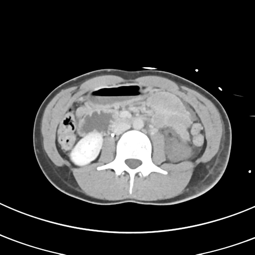 File:Abdominal multi-trauma - devascularised kidney and liver, spleen and pancreatic lacerations (Radiopaedia 34984-36486 Axial C+ delayed 38).png