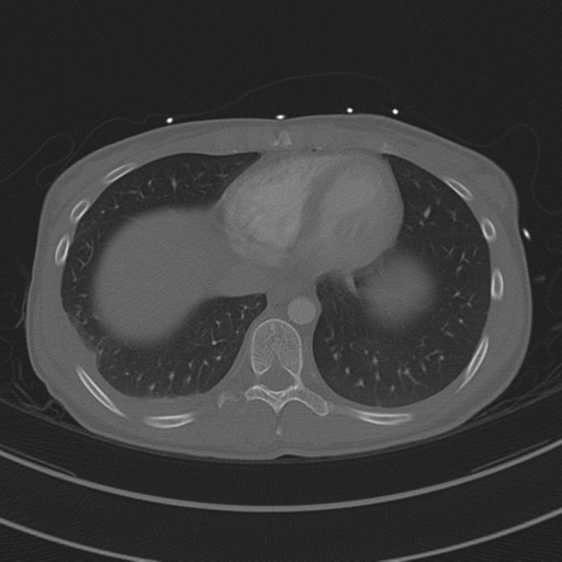 File:Abdominal multi-trauma - devascularised kidney and liver, spleen and pancreatic lacerations (Radiopaedia 34984-36486 I 65).png