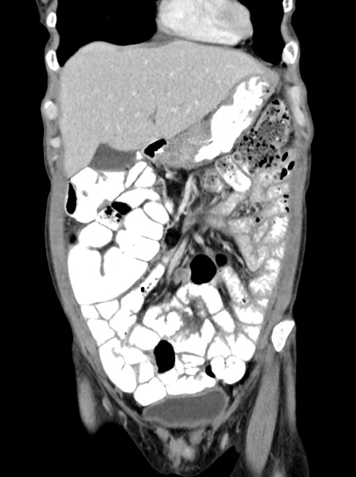 Abdominal wall and retroperitoneal tuberculosis (Radiopaedia 88137-104729 Coronal C+ portal venous phase 27).jpg