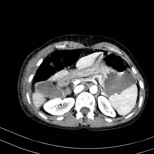 Abdominal wall hematoma with active bleeding (Radiopaedia 83915-99117 Axial renal cortical phase 6).jpg