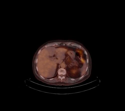 Abdominal wall metastasis from colorectal carcinoma (Radiopaedia 31016-31719 C 85).jpg