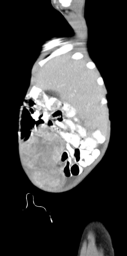 Abdominopelvic rhabdomyosarcoma (Radiopaedia 78356-90984 Sagittal C+ portal venous phase 87).jpg