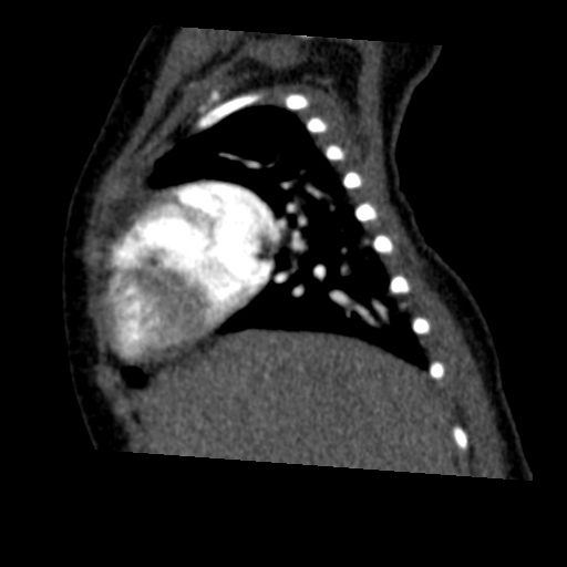 Aberrant left pulmonary artery (pulmonary sling) (Radiopaedia 42323-45435 Sagittal C+ arterial phase 14).jpg