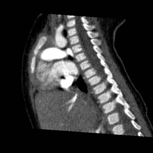 Aberrant left pulmonary artery (pulmonary sling) (Radiopaedia 42323-45435 Sagittal C+ arterial phase 28).jpg