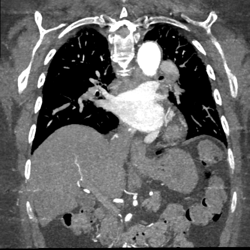 File:Aberrant right subclavian artery with Kommerell diverticulum (Radiopaedia 47982-52769 Coronal C+ arterial phase 45).png