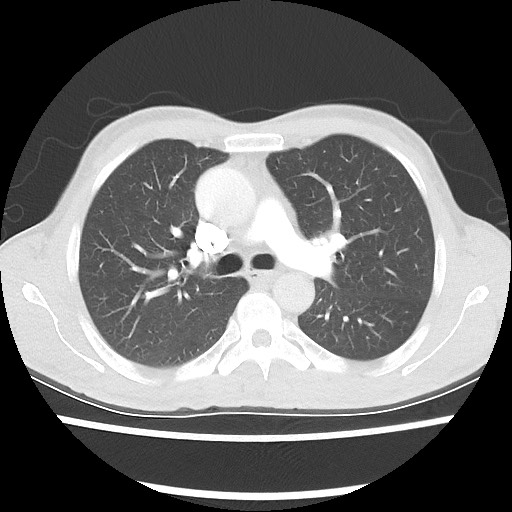 Accessory left horizontal fissure with lingular pneumonia (Radiopaedia 53763-59843 Axial lung window 24).jpg