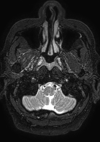 Accessory middle cerebral artery (Radiopaedia 73114-83828 Axial T2 212).jpg