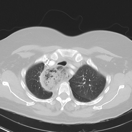 File:Achalasia (Radiopaedia 47147-51685 Axial lung window 11).png