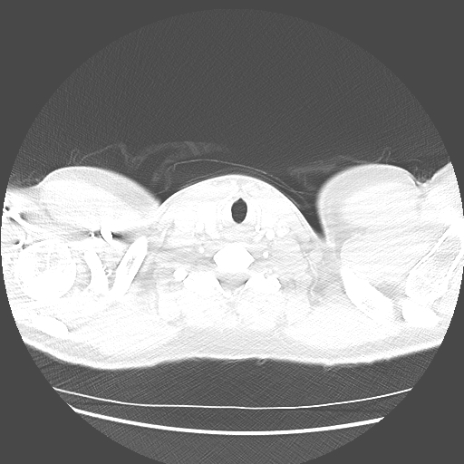 Achalasia (Radiopaedia 52507-58417 Axial lung window 1).jpg