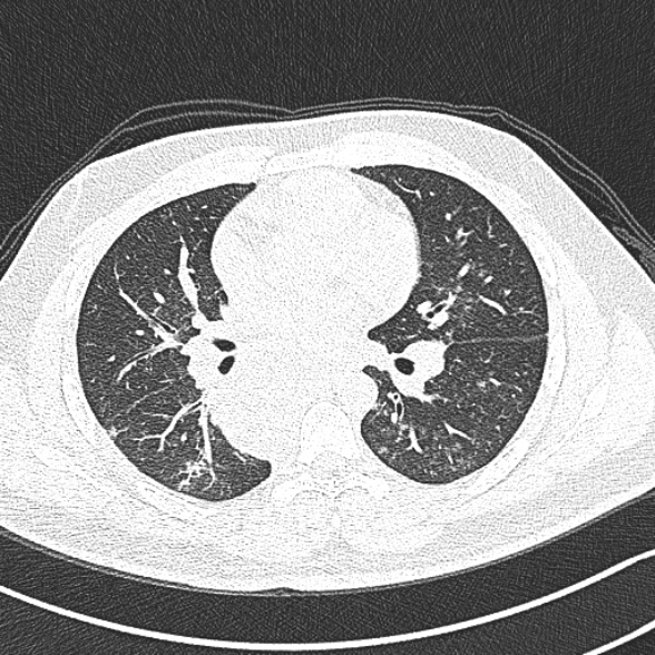 Achalasia with aspiration (Radiopaedia 55413-61845 Axial lung window 37).jpg