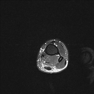 File:Achilles tendon tear (Radiopaedia 77615-89819 Axial STIR 1).jpg