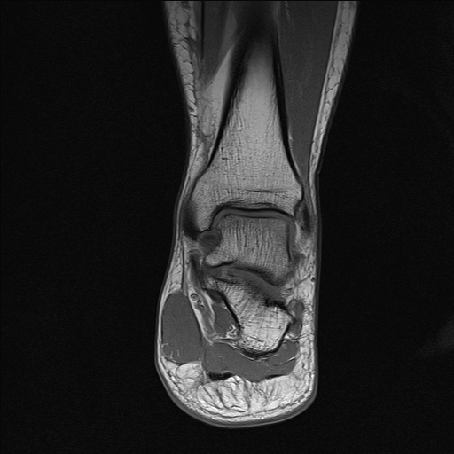 File:Achilles tendon tear (Radiopaedia 77615-89819 Coronal T1 17).jpg