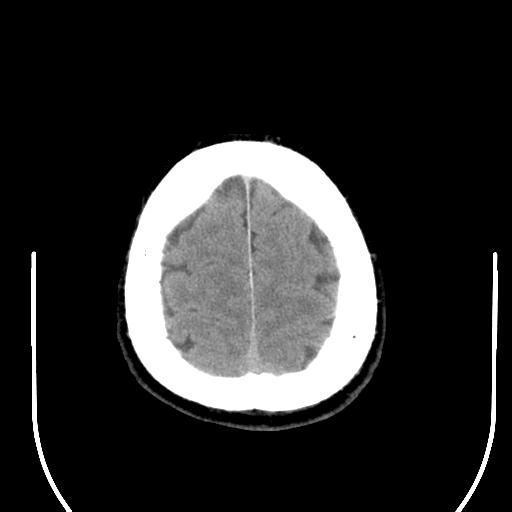 File:Acoustic schwannoma (Radiopaedia 29488-29982 AXIAL THICK non-contrast 43).jpg
