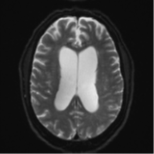 File:Acoustic schwannoma (Radiopaedia 55729-62281 E 17).png