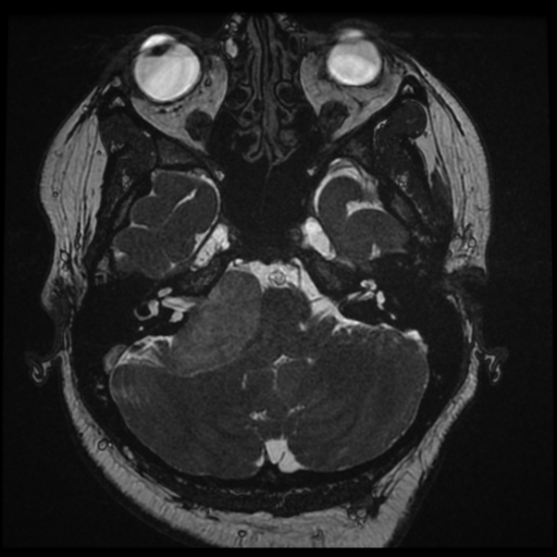 Acoustic schwannoma (Radiopaedia 57574-64536 Axial T2 26).png