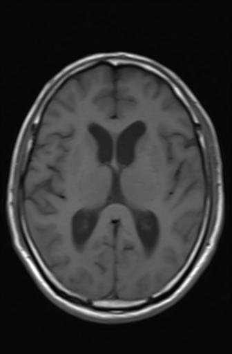 Acoustic schwannoma - probable (Radiopaedia 20386-20292 Axial T1 11).jpg
