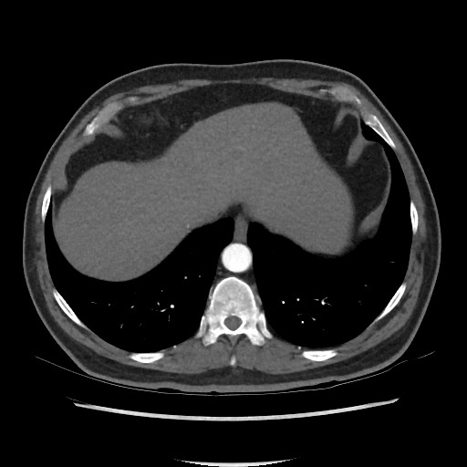File:Active colonic bleed on CT (Radiopaedia 49765-55025 Axial C+ arterial phase 12).jpg