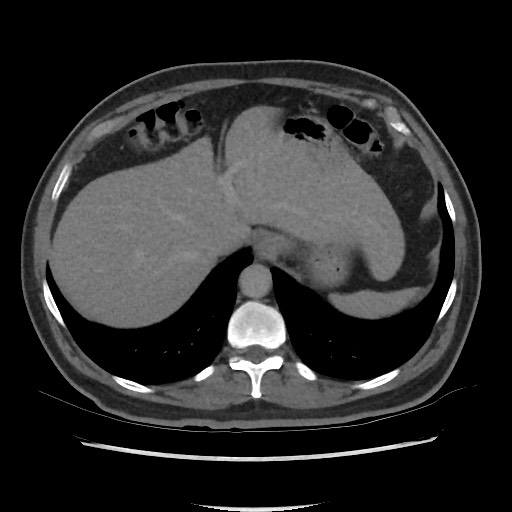 File:Active colonic bleed on CT (Radiopaedia 49765-55025 Axial C+ delayed 15).jpg