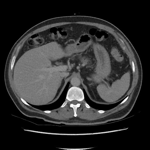 File:Active colonic bleed on CT (Radiopaedia 49765-55025 Axial C+ delayed 21).jpg