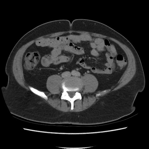 File:Active colonic bleed on CT (Radiopaedia 49765-55025 Axial C+ delayed 51).jpg