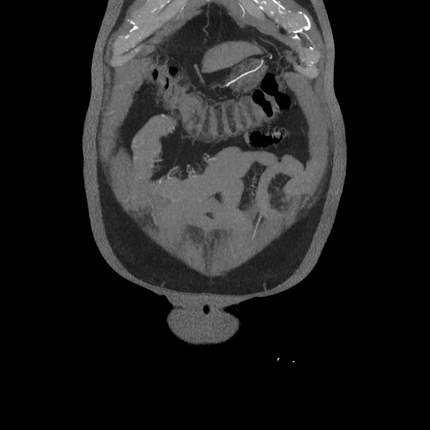 Active colonic bleed on CT (Radiopaedia 49765-55025 Coronal art MIP 13).jpg