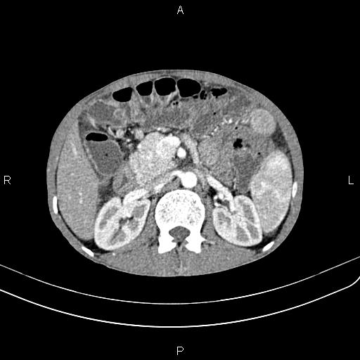 Active crohn disease (Radiopaedia 87133-103397 Axial C+ arterial phase 40).jpg