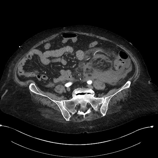 Active renal extravasation with large subcapsular and retroperitoneal hemorrhage (Radiopaedia 60975-68796 Axial C+ arterial phase 133).jpg