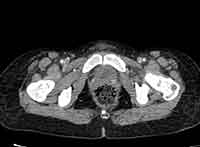 Acute Budd-Chiari syndrome (Radiopaedia 60858-68638 A 299).jpg