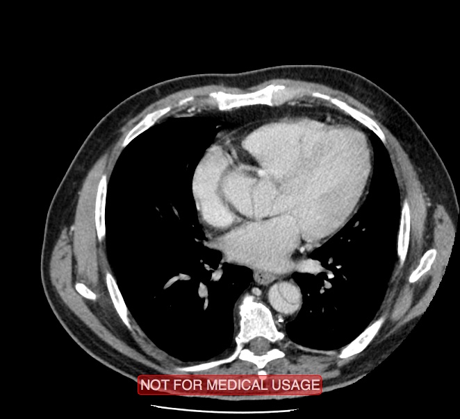 Acute aortic dissection - Stanford type A (Radiopaedia 40661-43285 Axial C+ portal venous phase 34).jpg