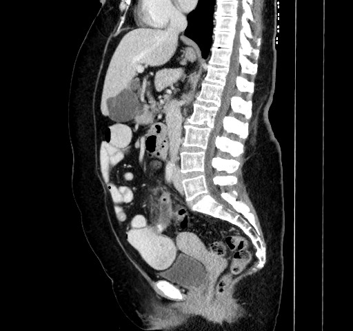 File:Acute appendicitis, heterotaxy syndrome (Radiopaedia 66884-76202 Sagittal C+ portal venous phase 69).jpg