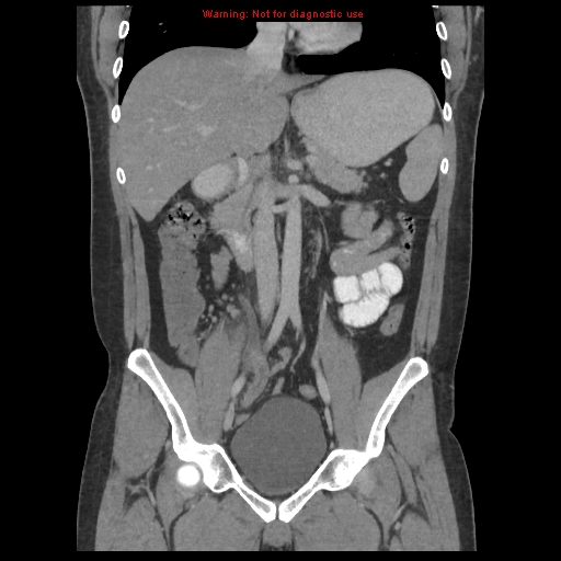 File:Acute appendicitis (Radiopaedia 10498-10973 F 18).jpg