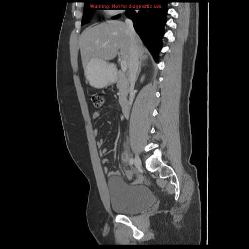 File:Acute appendicitis (Radiopaedia 10498-10973 Sagittal C+ portal venous phase 21).jpg