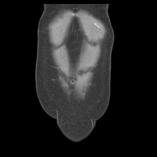 Acute appendicitis (Radiopaedia 30297-30934 Coronal C+ portal venous phase 5).jpg