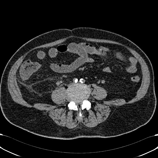 File:Acute appendicitis (Radiopaedia 58627-65818 Axial non-contrast 54).jpg