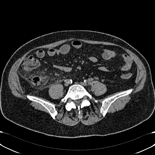 Acute appendicitis (Radiopaedia 58627-65818 Axial non-contrast 58).jpg