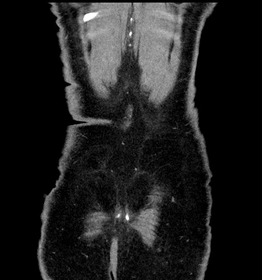 Acute appendicitis (Radiopaedia 77016-88960 Coronal C+ portal venous phase 91).jpg