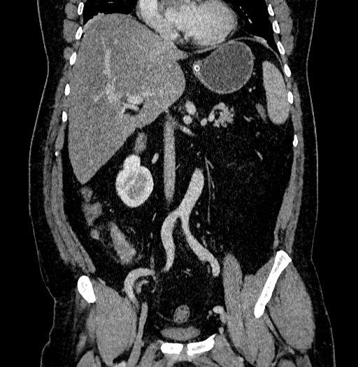 Acute appendicitis (Radiopaedia 79950-93224 Coronal C+ portal venous phase 46).jpg