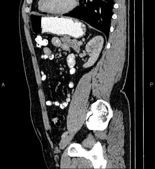 Acute appendicitis (Radiopaedia 84780-100240 Sagittal C+ portal venous phase 71).jpg