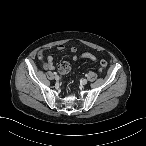 Acute appendicitis - large appendicoliths (Radiopaedia 61805-69820 Axial C+ portal venous phase 100).jpg