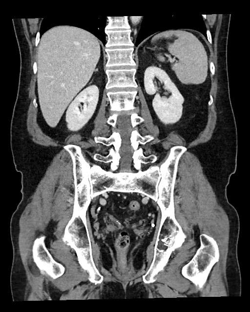 Acute appendicitis - large appendicoliths (Radiopaedia 61805-69820 Coronal C+ portal venous phase 93).jpg