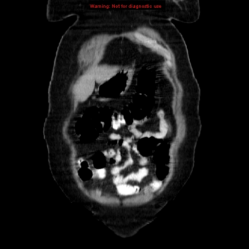 Acute appendicitis complicated by ovarian vein thrombophlebitis (Radiopaedia 16172-15851 Coronal C+ portal venous phase 16).jpg
