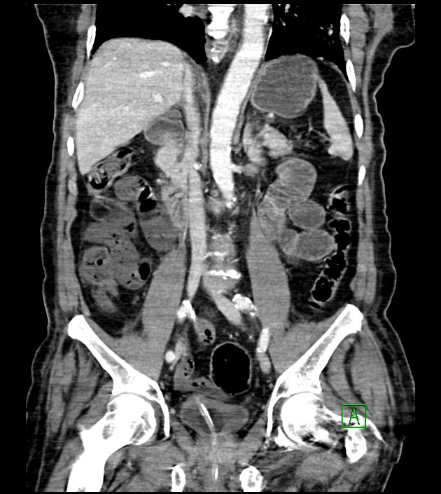 Acute arterial mesenteric ischemia (Radiopaedia 78238-90828 Coronal C+ portal venous phase 54).jpg