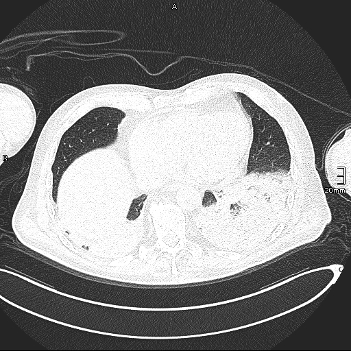 Acute aspiration pneumonitis (Radiopaedia 55642-62166 Axial lung window 116).jpg
