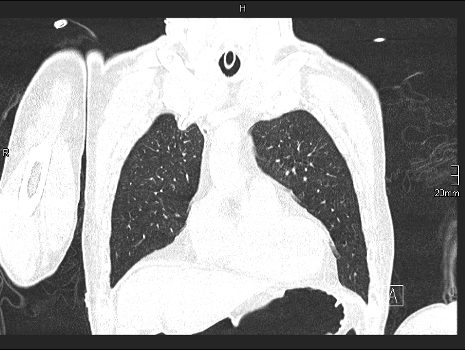 Acute aspiration pneumonitis (Radiopaedia 55642-62166 Coronal lung window 24).jpg