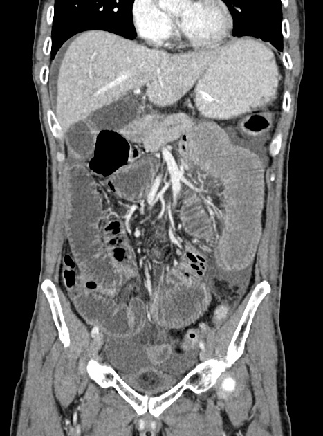 Acute bowel ischemia (Radiopaedia 87695-104114 Coronal C+ portal venous phase 171).jpg