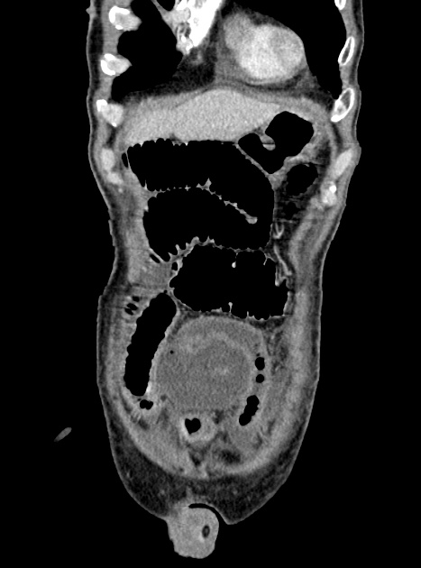 Acute bowel ischemia (Radiopaedia 87695-104114 Coronal C+ portal venous phase 99).jpg