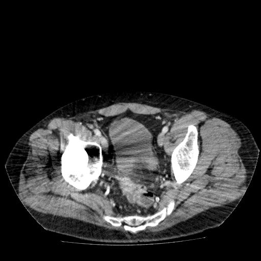 File:Acute cholecystitis and incidental left sided IVC (Radiopaedia 49352-54459 Axial C+ portal venous phase 136).jpg